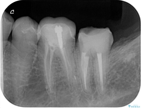 被せ物が割れた、虫歯の再発の治療 治療中画像