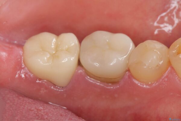 被せ物が割れた、虫歯の再発の治療 治療後画像