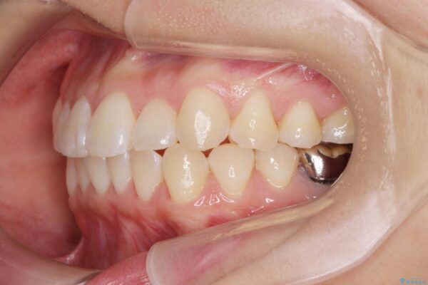 引っ込んだ前歯、正中のズレの矯正 治療後画像