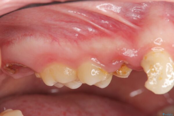歯周外科を行った虫歯治療[ 歯肉縁下齲蝕 ] 治療前画像