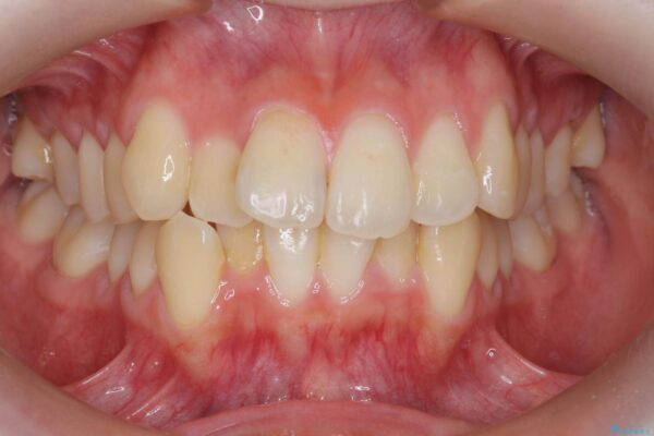 マウスピースで前歯のがたつき矯正 治療前画像