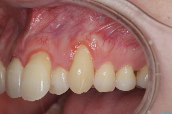 歯ぐきのさがりが気になる 歯肉移植 根面被覆による改善 ビフォー