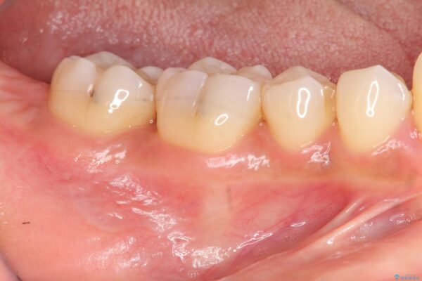 歯を残す再生治療[ 歯周病 ] ビフォー