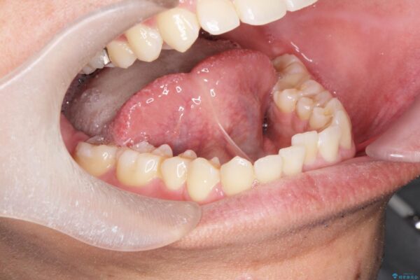 舌の小帯の形成手術　[滑舌を良くしたい] 治療前画像