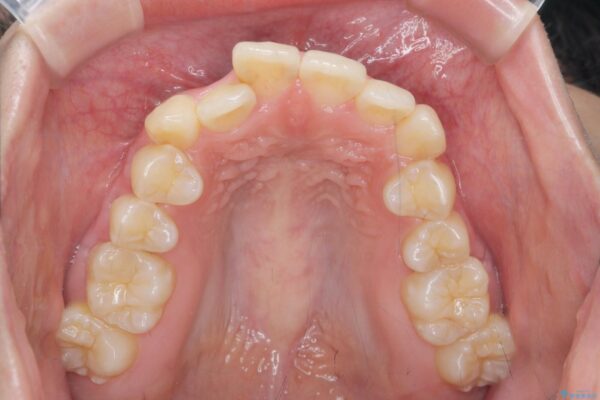 マウスピースで前歯のがたつき矯正 治療前画像
