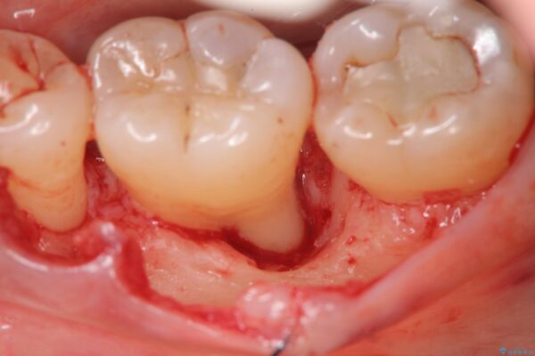 歯を残す再生治療[ 歯周病 ] 治療前画像