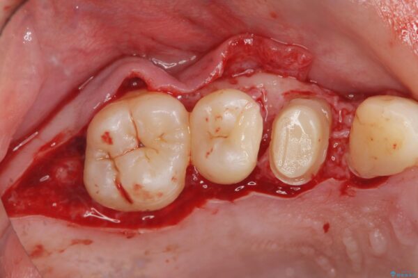歯周外科を行った虫歯治療[ 歯肉縁下齲蝕 ] 治療中画像
