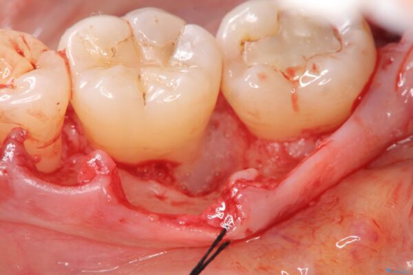 歯を残す再生治療[ 歯周病 ] 治療中画像