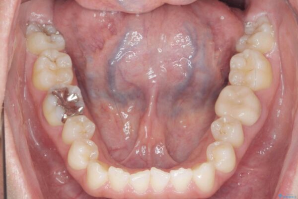 歯を抜かないマウスピース矯正[ 前歯の引っ込みを治したい ] 治療前画像