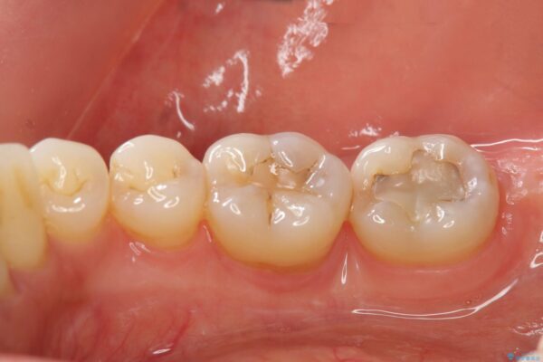 歯を残す再生治療[ 歯周病 ] 治療後画像