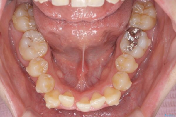 マウスピースで前歯のがたつき矯正 治療中画像