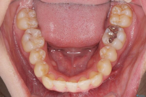 マウスピースで前歯のがたつき矯正 治療後画像