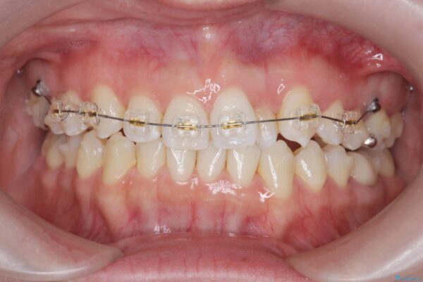 歯を抜かないマウスピース矯正[ 前歯の引っ込みを治したい ] 治療中画像