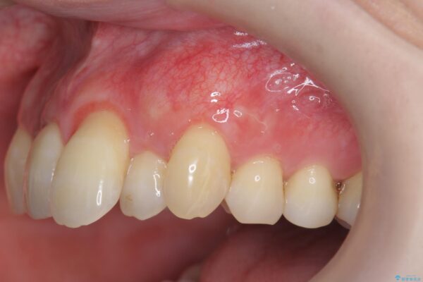 歯ぐきのさがりが気になる 歯肉移植 根面被覆による改善 アフター
