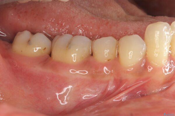 歯を残す再生治療[ 歯周病 ] アフター
