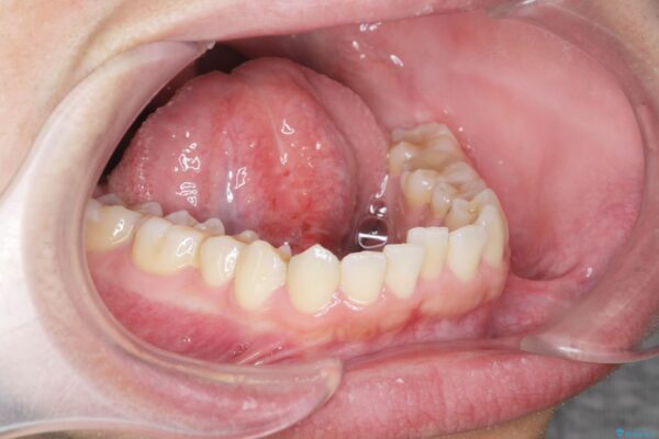 舌の小帯の形成手術　[滑舌を良くしたい] 治療後画像