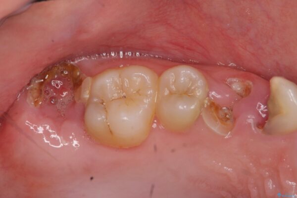 歯周外科を行った虫歯治療[ 歯肉縁下齲蝕 ] 治療前画像