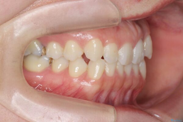歯を抜かないマウスピース矯正[ 前歯の引っ込みを治したい ] 治療前画像