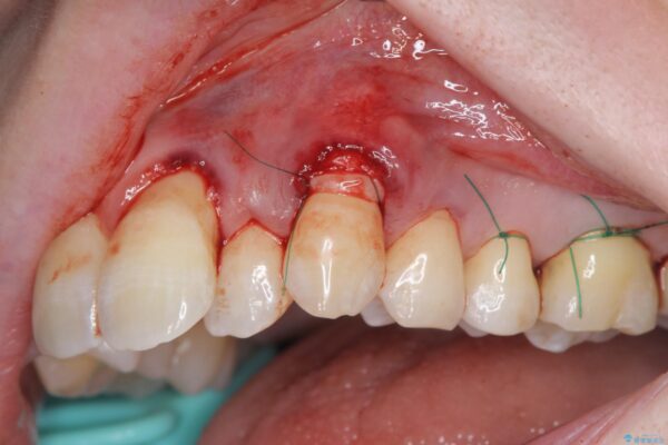 歯ぐきのさがりが気になる 歯肉移植 根面被覆による改善 治療中画像