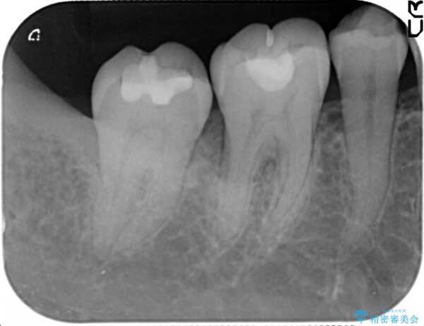 歯を残す再生治療[ 歯周病 ] 治療前画像