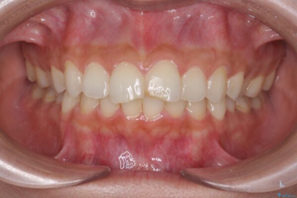 すり減ってしまった前歯の形態回復 治療前画像