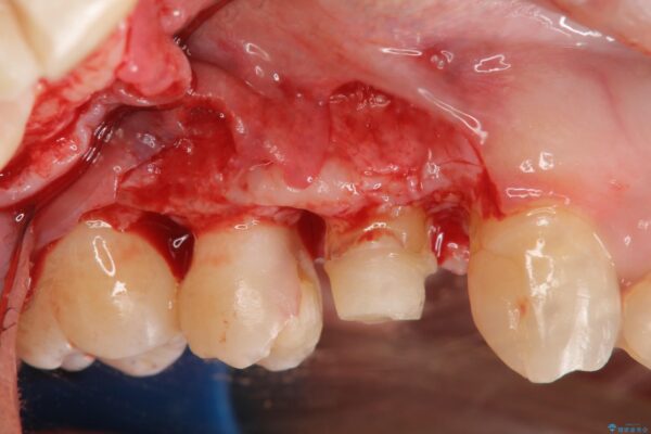 歯周外科を行った虫歯治療[ 歯肉縁下齲蝕 ] 治療中画像