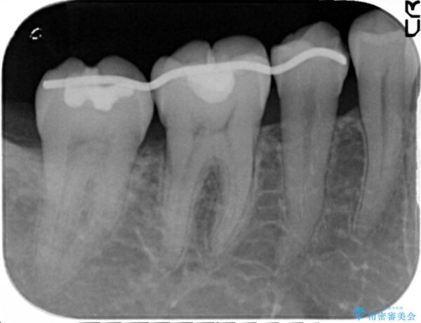 歯を残す再生治療[ 歯周病 ] 治療中画像