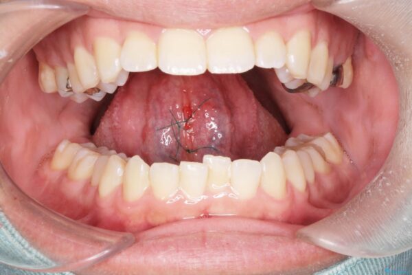 舌の小帯の形成手術　[滑舌を良くしたい] 治療中画像