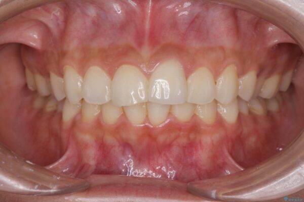 すり減ってしまった前歯の形態回復 治療後画像