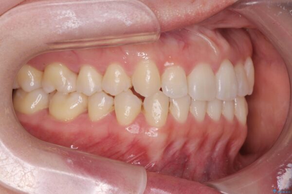 歯を抜かないマウスピース矯正[ 前歯の引っ込みを治したい ] 治療後画像