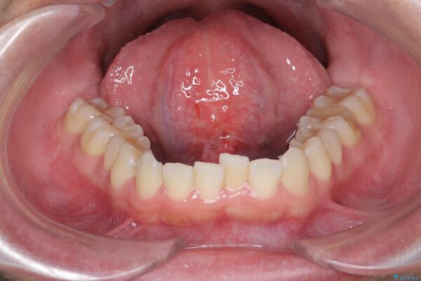 舌の小帯の形成手術　[滑舌を良くしたい] 治療後画像