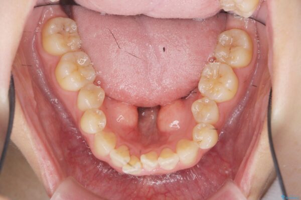 舌のスペースが狭く話しにくいのを改善したい[ 下顎骨隆起の切除 ] 治療前画像