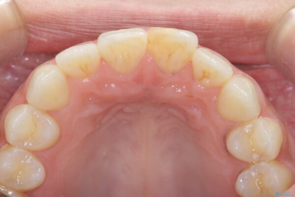 すり減ってしまった前歯の形態回復 治療前画像