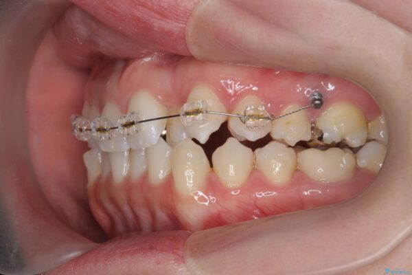 歯を抜かないマウスピース矯正[ 前歯の引っ込みを治したい ] 治療中画像