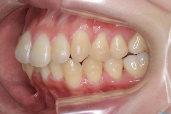 マウスピースで前歯のがたつき矯正 治療中画像
