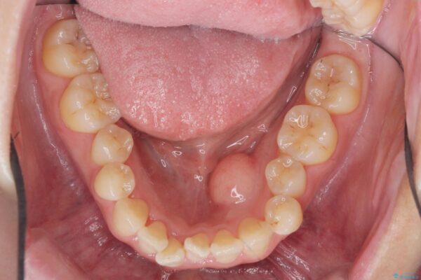 舌のスペースが狭く話しにくいのを改善したい[ 下顎骨隆起の切除 ] 治療後画像
