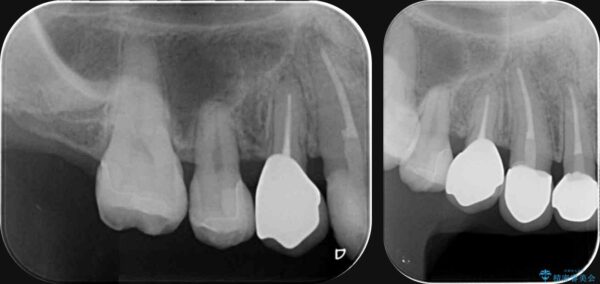 歯周外科を行った虫歯治療[ 歯肉縁下齲蝕 ] 治療後画像