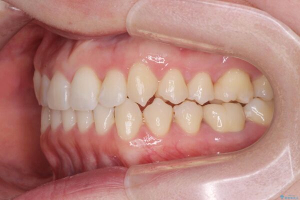 歯を抜かないマウスピース矯正[ 前歯の引っ込みを治したい ] 治療後画像