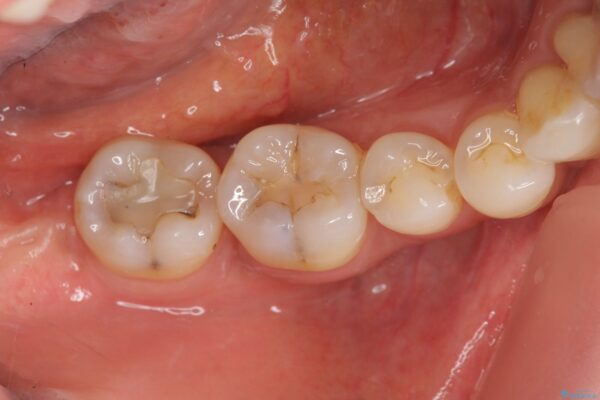歯を残す再生治療[ 歯周病 ] 治療後画像