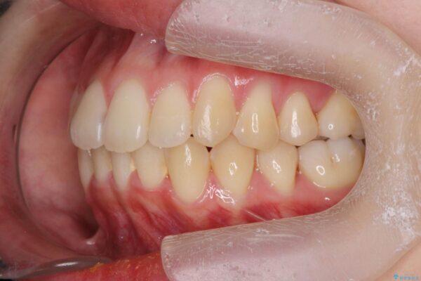 マウスピースで前歯のがたつき矯正 治療後画像