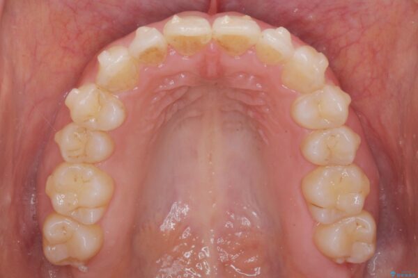 がたついた歯並びを治したい[ マウスピース矯正 ] 治療中画像
