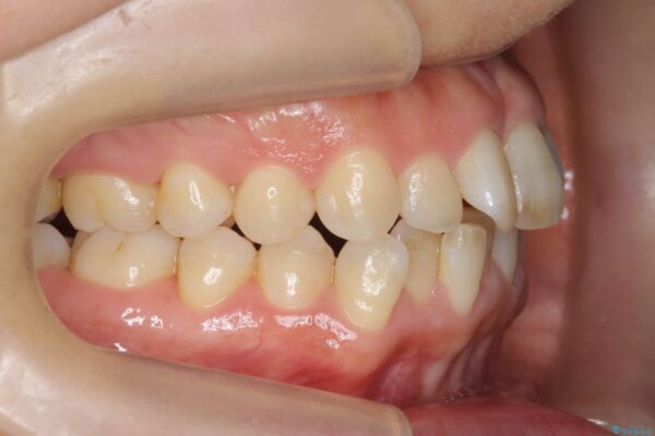 がたついた歯並びを治したい[ マウスピース矯正 ] 治療前画像