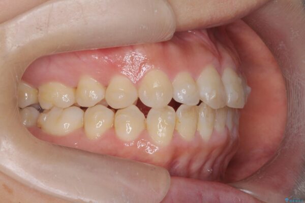 がたついた歯並びを治したい[ マウスピース矯正 ] 治療中画像