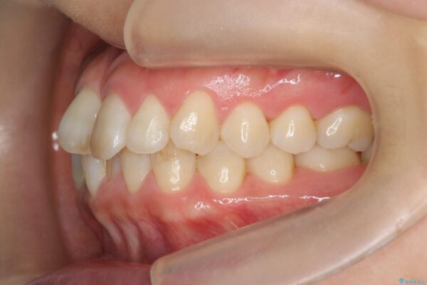がたついた歯並びを治したい[ マウスピース矯正 ] 治療前画像