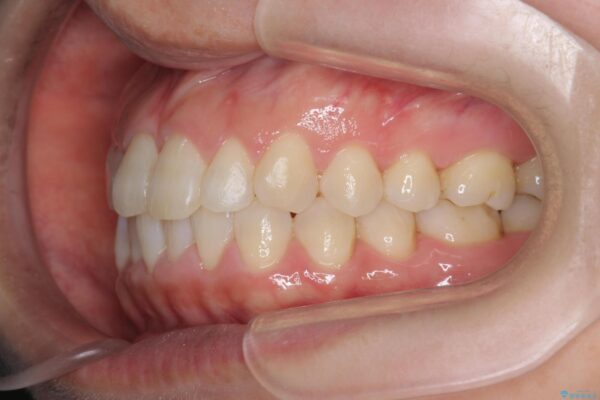がたついた歯並びを治したい[ マウスピース矯正 ] 治療後画像