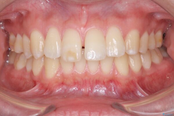 目立つ歯の隙間をマウスピース矯正で改善 ビフォー
