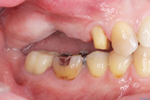 骨の造成を伴う奥歯のインプラント治療 治療前画像