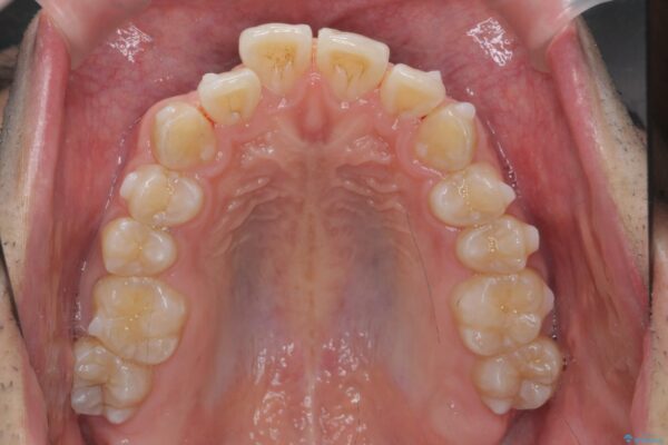 マウスピース矯正で前歯の角度、ガタつきをきれいに 治療中画像