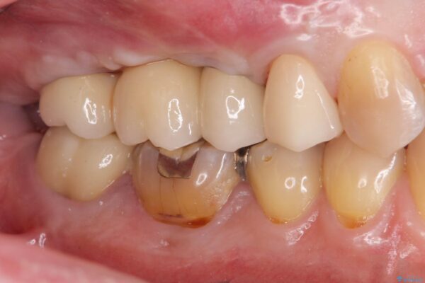 骨の造成を伴う奥歯のインプラント治療 治療後画像