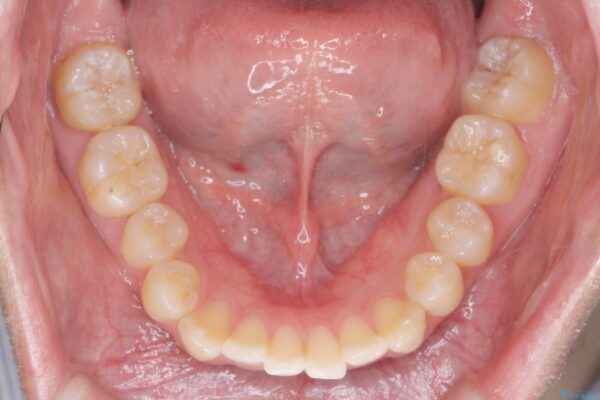 目立つ歯の隙間をマウスピース矯正で改善 治療前画像